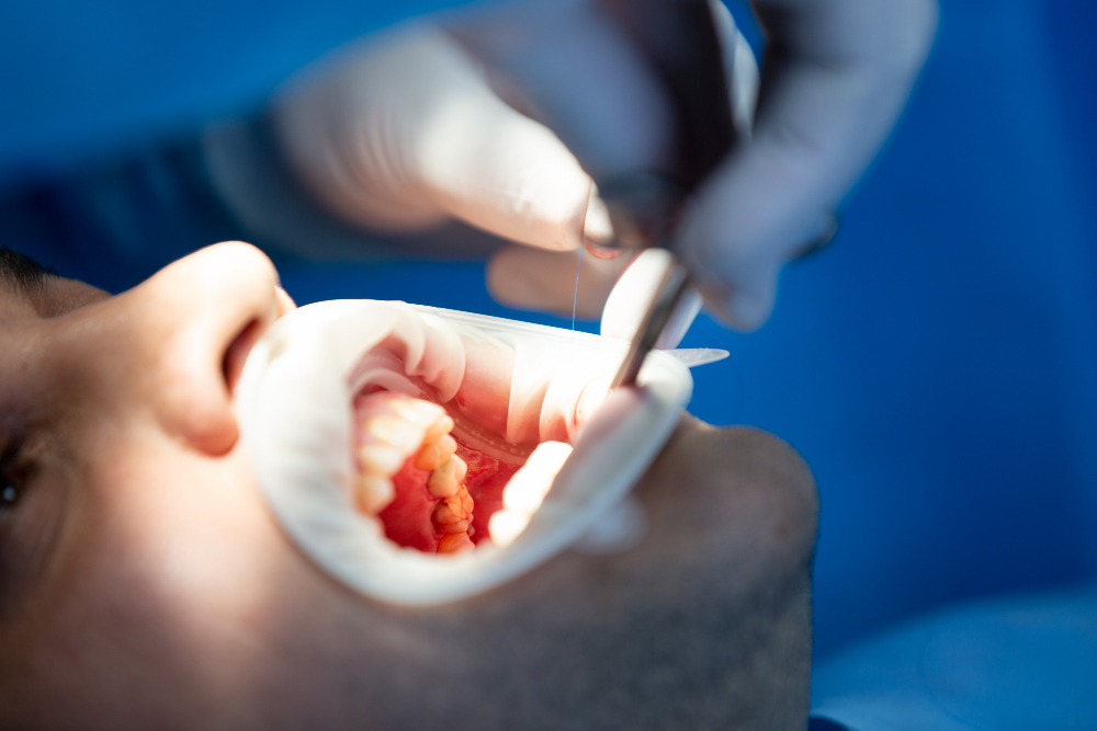 Root Canal Treatment: What Really Happens