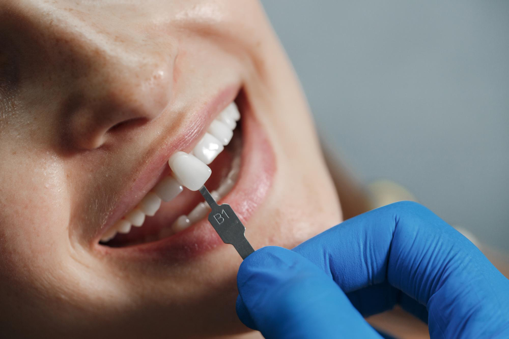 Crowning Your Smile: What You Should Know About Dental Crowns