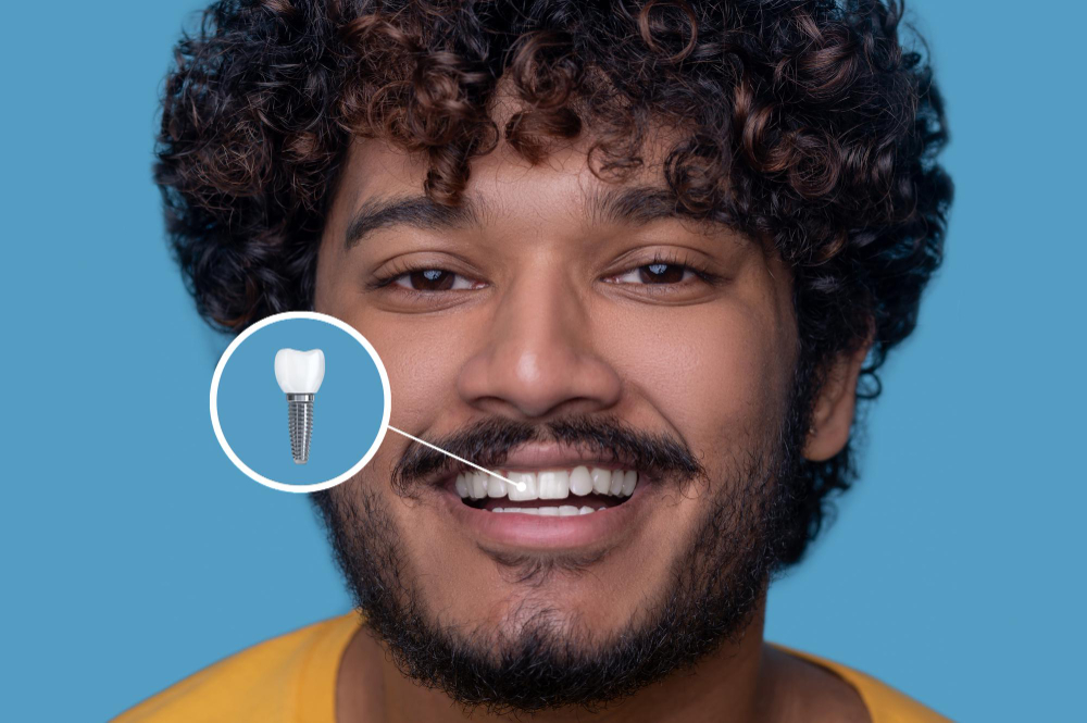What Is a Dental Implant? Everything You Need to Know
