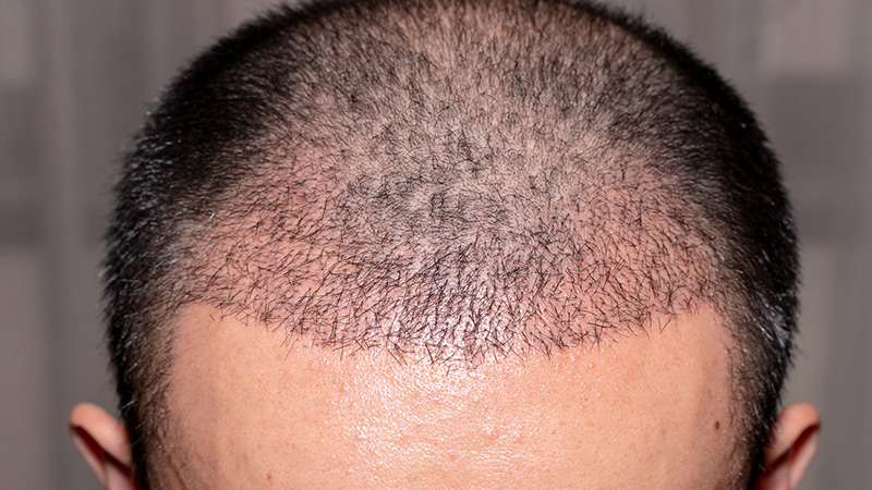 How To Do Hair Transplantation?