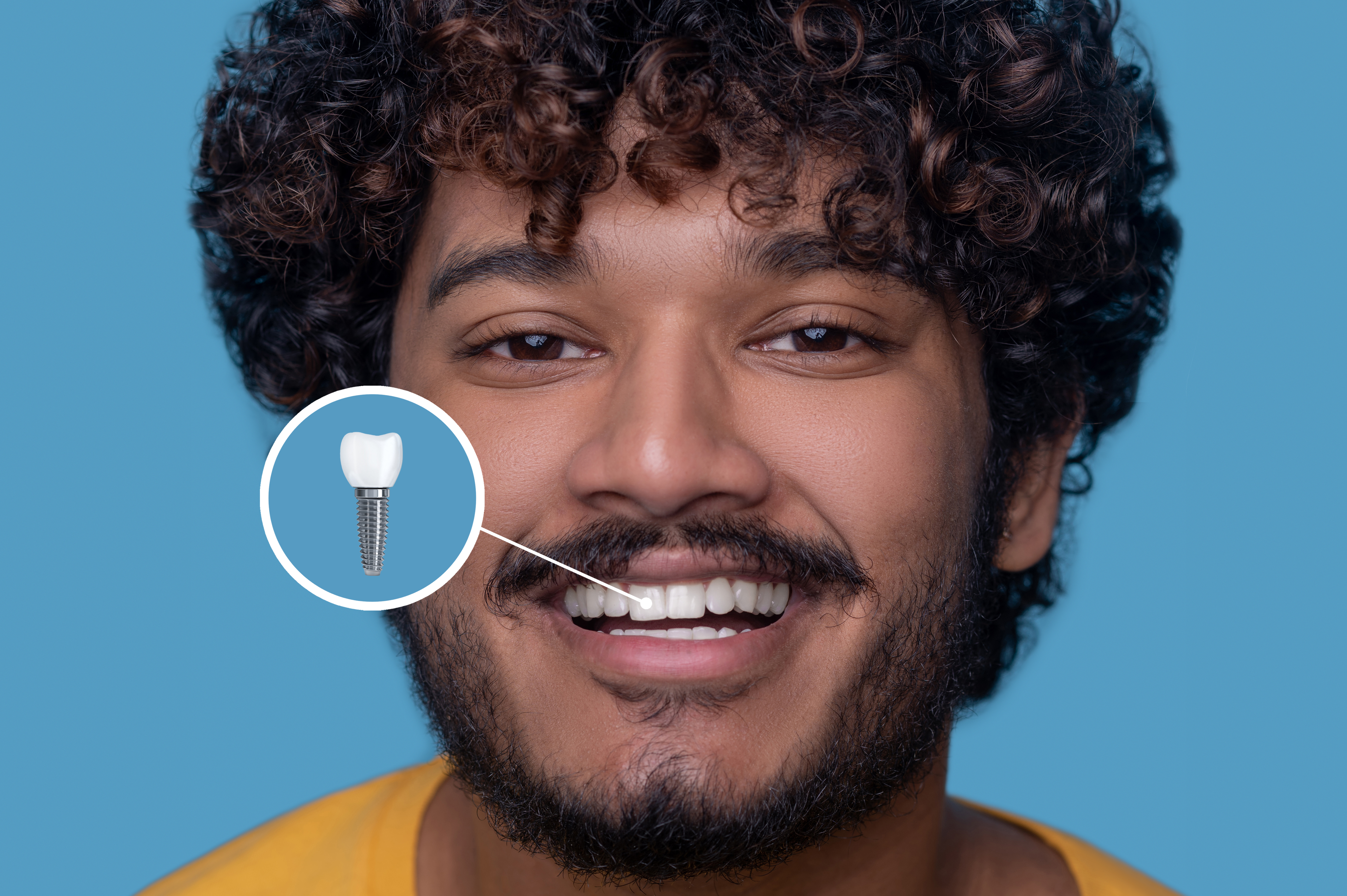 Dental Implants: A Detailed Guide